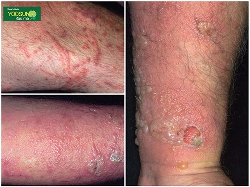 Biểu hiện của viêm da tiếp xúc là gì vậy Biểu hiện của viêm da tiếp xúc là gì