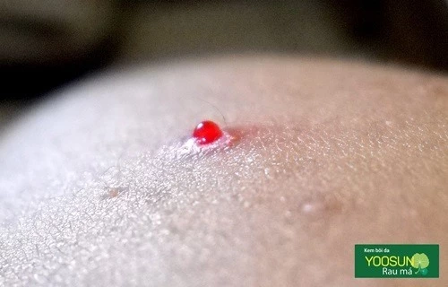 Cách chữa mụn bọc mủ có máu