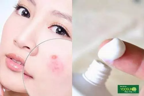 Cách chữa mụn bọc sưng không đầu