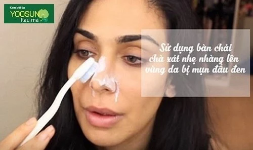 Cách trị mụn ở mũi nhanh nhất
