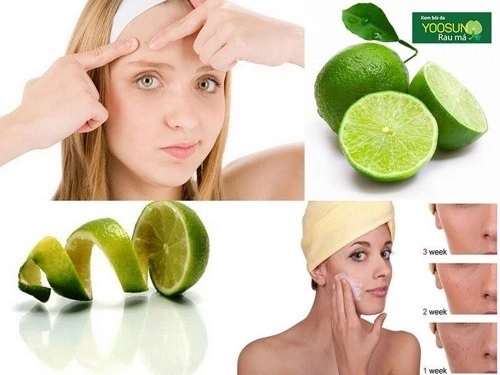 Cách trị mụn trên trán tại nhà