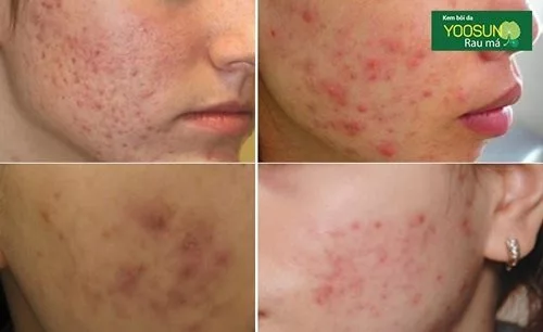 Cách trị thâm mụn tại nhà hiệu quả