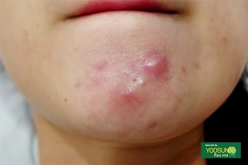 Da bị mụn bọc là gì