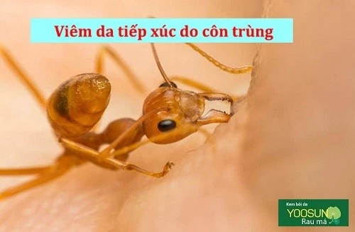 Điều trị viêm da tiếp xúc côn trùng ra sao? Điều trị viêm da tiếp xúc côn trùng