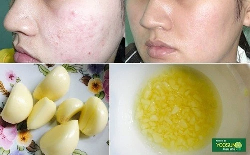 Dùng tỏi trị mụn có tốt không