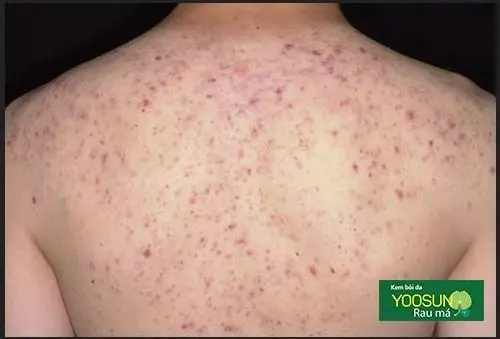 Giải mã vị trí mụn trên cơ thể