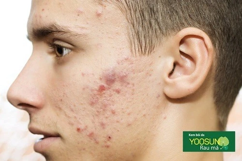 Lên mụn ở trán và má