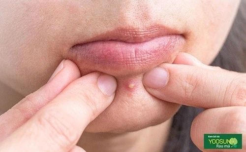 mọc mụn ở cằm nguyên nhân