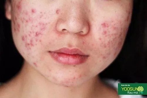 Mọc mụn ở cằm và má