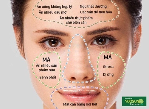 Mọc mụn ở trán biểu hiện bệnh gì