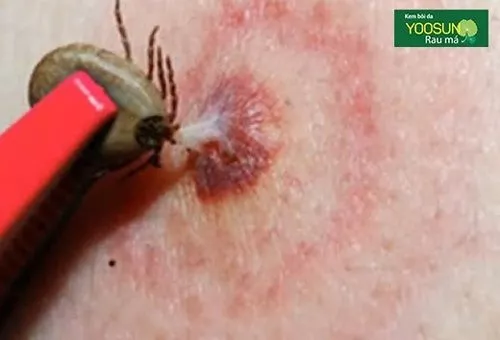 Người bị ve chó cắn có nguy hiểm không