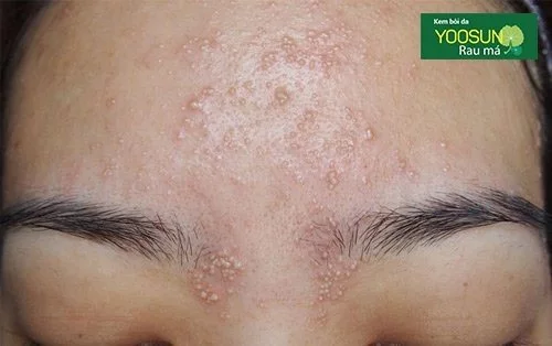 Nguyên nhân bị mụn trên trán và chân mày