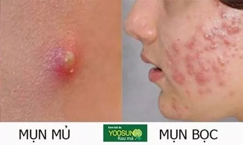 Nguyên nhân gây mụn bọc là gì
