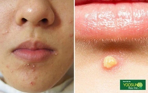 Nguyên nhân gây mụn bọc ở cằm