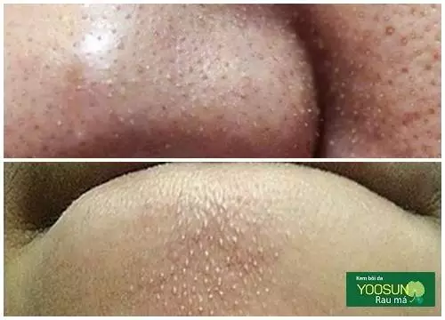Nổi mụn ở mũi là bệnh gì
