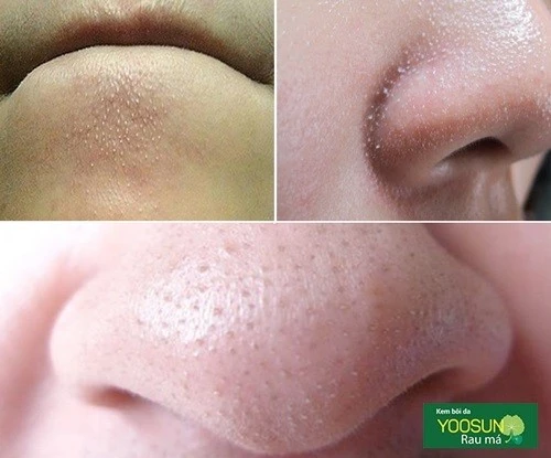 Sợi bã nhờn màu trắng