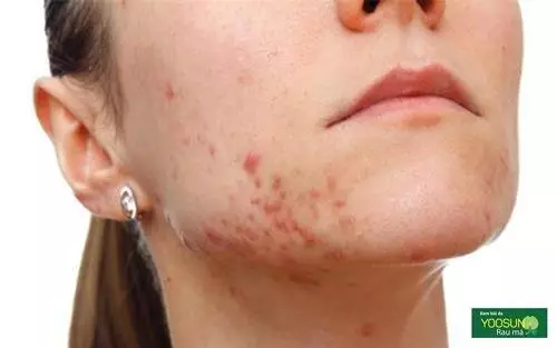 Tại sao mụn mọc ở cằm