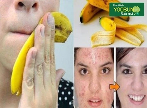 Trị thâm mụn sau 1 đêm bằng chuối