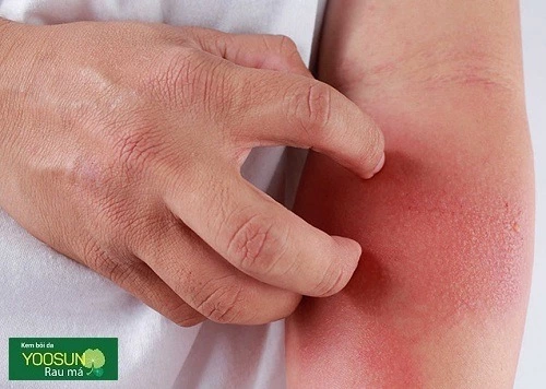 Viêm da tiếp xúc bệnh học là gì Viêm da tiếp xúc bệnh học