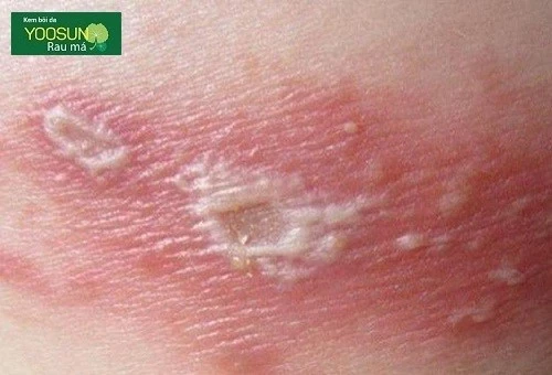 Viêm da tiếp xúc và zona khác nhau như thế nào? viêm da tiếp xúc và zona