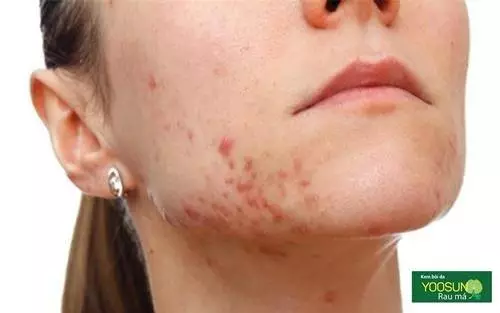Xem vị trí mụn đoán bệnh