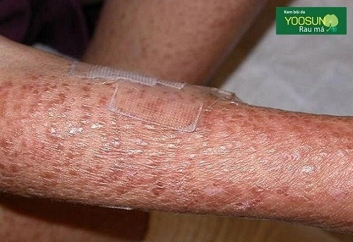 Các bệnh ngoài da ở trẻ em