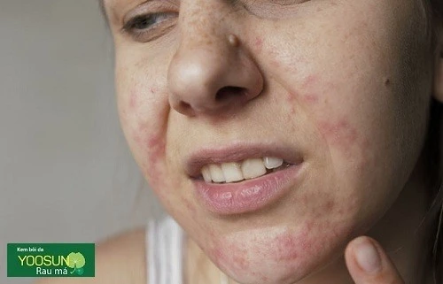 Cách chữa dị ứng nước hoa hồng