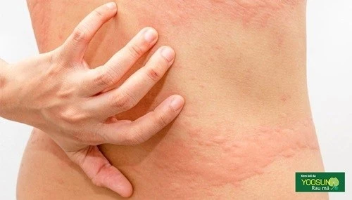 Da nổi ban đỏ không ngứa không sốt