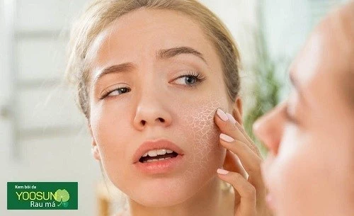 Dấu hiệu dị ứng nước hoa hồng thayer