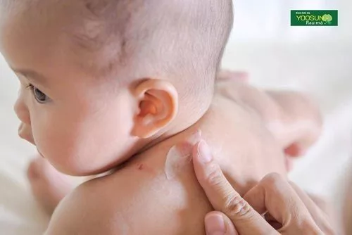 Kem trị muỗi đốt cho bé loại nào tốt