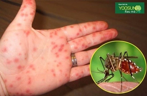 Nổi phát ban đỏ sốt xuất huyết