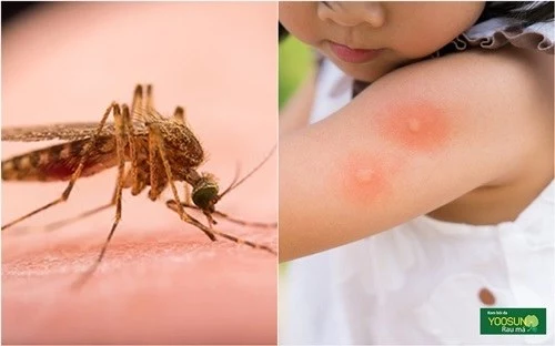Thuốc bôi muỗi đốt cho bé