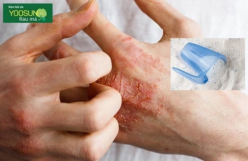 Bị dị ứng xà phòng ở tay