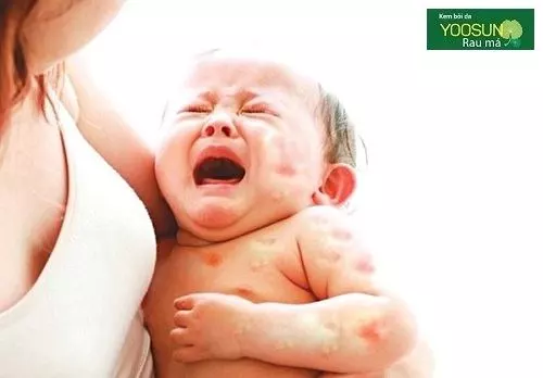 Biểu hiện dị ứng trứng gà ở trẻ em