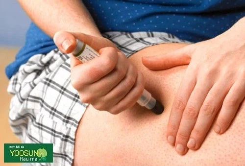 Cách xử lý dị ứng trứng gà
