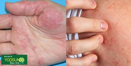 Da tay dị ứng với xà phòng