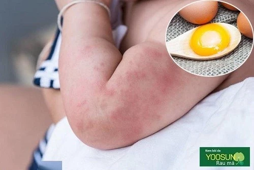 Dị ứng trứng ở trẻ dưới 1 tuổi
