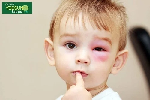 Trẻ bị côn trùng đốt sưng mắt
