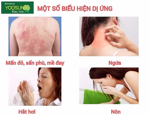 Bị dị ứng sưng môi trên