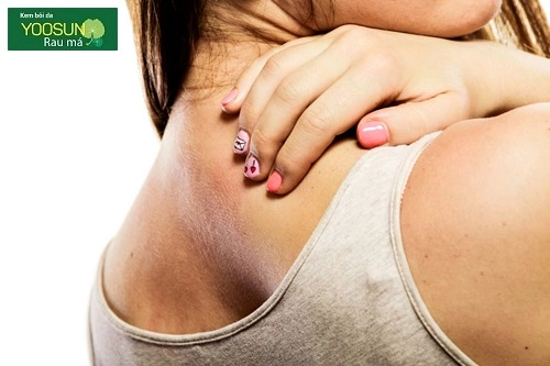 Dấu hiệu dị ứng kem body