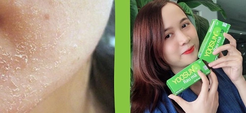 Da khô dùng kem dưỡng ẩm nào