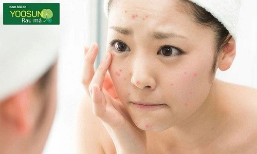 Bị mụn nội tiết là như thế nào