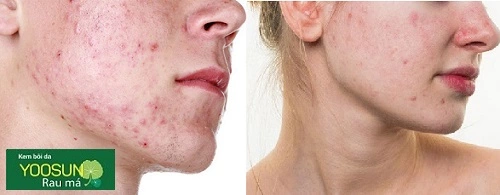 Mụn nội tiết là gì