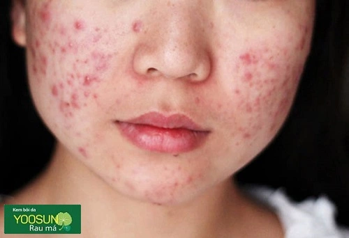 Vị trí mụn nội tiết thường mọc ở đâu