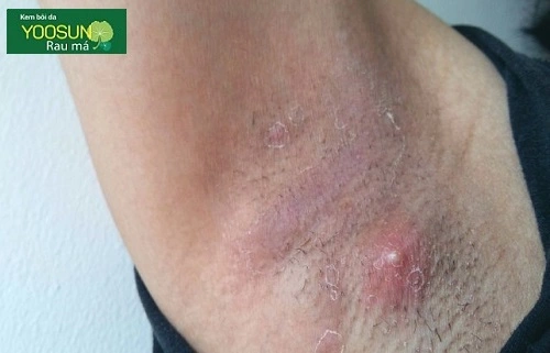 Bị mọc mụn ở nách đau