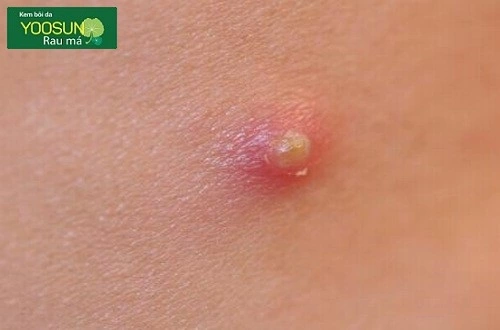 Bị mụn ở nách có nguy hiểm không