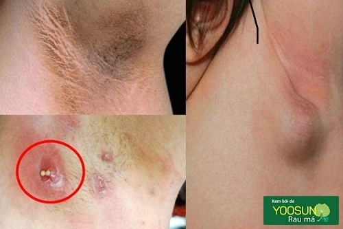 Mụn mọc ở nách là bệnh gì