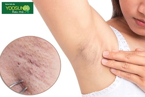 Nguyên nhân nổi mụn nách