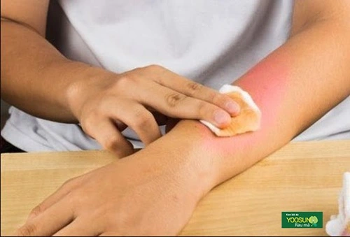 Bị bỏng hơi nước phải làm sao
