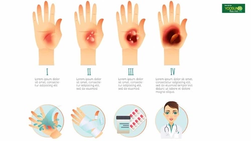 Cách chữa bỏng hơi nước sôi
